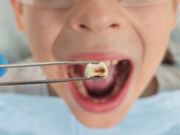 Best Emergency Broken Tooth Repair in Kdeer, IL